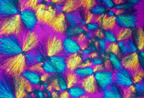 Postpartum depression is likely caused by a variety of factors.