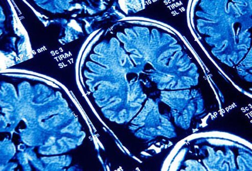 Postpartum psychosis is a severe mental illness that some women experience, particularly those who have a personal or family history of schizophrenia or bipolar disorder.