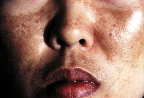 During the first trimester, the skin on your forehead, bridge of your nose, upper lip, or cheekbones may darken.