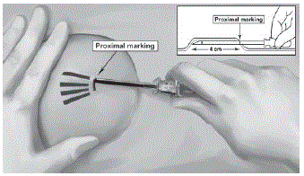 Gently push the obturator forward (mild resistance should be felt) until the obturator stop line is level with the bevel-up stop marking, which indicates the implant is positioned at the tip of the cannula - Illustration