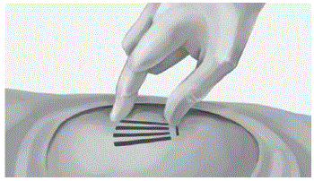 Mark the location of the implants with a surgical
marker - Illustration