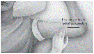 Lift the edge of the incision opening with a
toothed forceps - Illustration