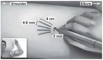 Lower the applicator to a horizontal position,
lift the skin up with the tip of the applicator but keep the cannula in the
subdermal connective tissue - Illustration