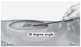 While tenting (lifting), gently advance
the applicator subdermally along the channel marking on the skin until the
proximal marking on the cannula just disappears into the incision - Illustration