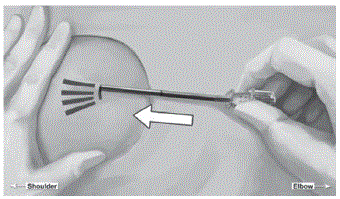 Insert one implant into the cannula - Illustration
