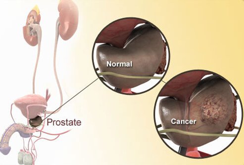 Prostate cancer is the development of cancer cells in the prostate gland.