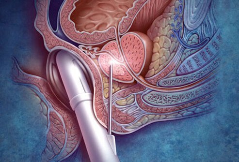 Photo of prostate biopsy.