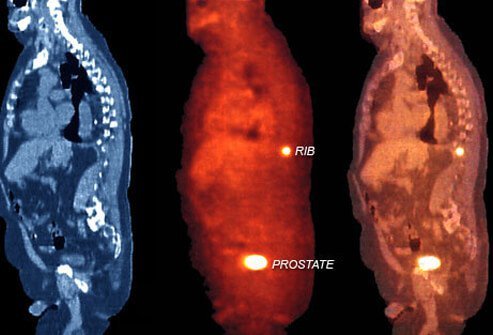 Photo of stages of prostate cancer.