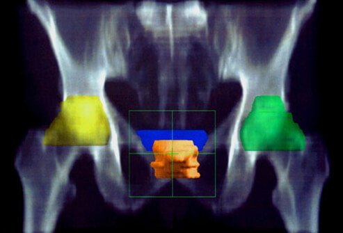 Photo of CT scan of pelvis.