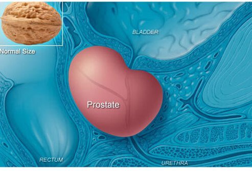 Two conditions can cause some symptoms that mimic those seen in prostate cancer described previously.