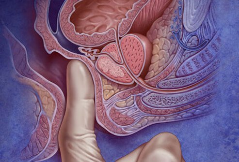 Photo of digital rectal exam.