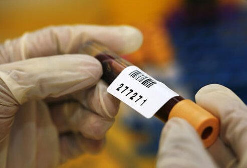In general, a PSA level less than 4 nanograms per milliliter (ng/mL) of blood is considered a normal level while a PSA greater than 10 ng/mL suggests a high risk of having cancer.