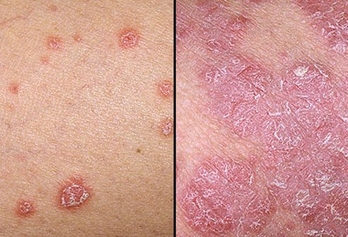 Although psoriatic plaques can be limited to only a few small areas, the condition can involve widespread areas of skin anywhere on the body.