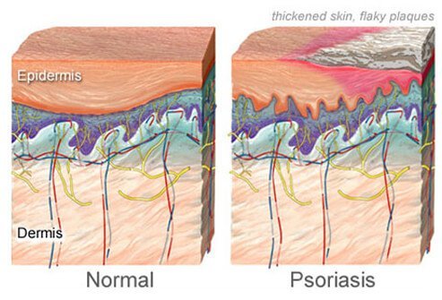 It is now clear that there is a genetic basis for psoriasis.