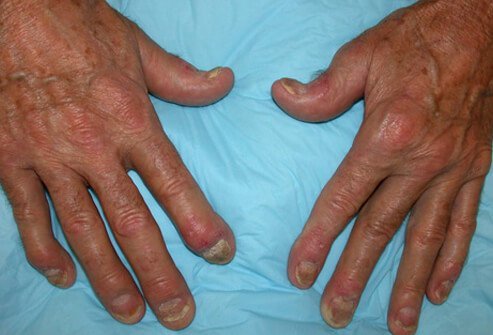 Psoriatic arthritis is a type of arthritis (inflammation of the joints) accompanied by inflammation of the skin (psoriasis).