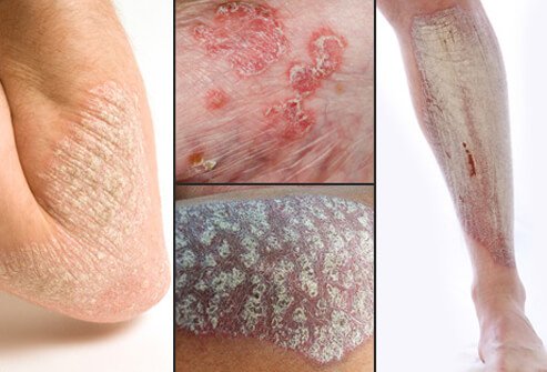 Psoriasis usually appears as red or pink plaques of raised, thick, scaly skin.