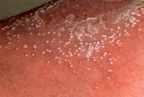 Pustular psoriasis consists of well-defined, white pustules on the skin.