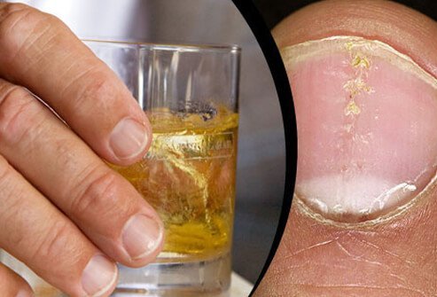 Some studies show a link between heavy alcohol drinking and psoriasis flares.