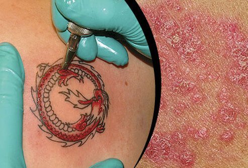 Tattoos are associated with skin trauma that may trigger psoriasis.