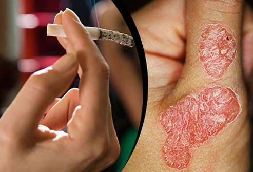 Smoking greatly increases the risk of psoriasis and makes the condition much worse.