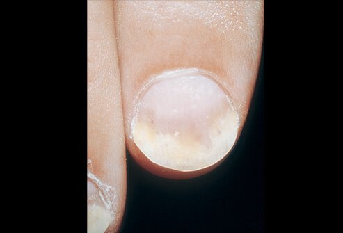 Picture of Psoriasis Vulgaris