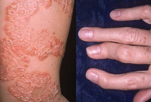 Psoriatic arthritis is a type of arthritis (inflammation of the joints) accompanied by inflammation of the skin (psoriasis).