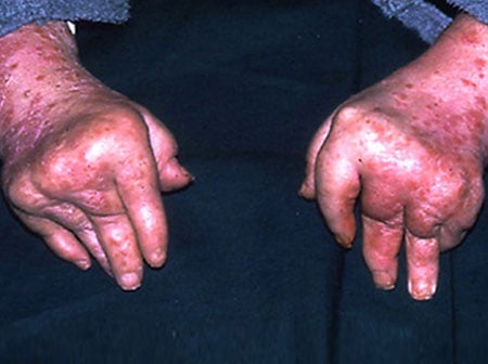 Psoriatic arthritis can cause swollen, red, and painfully inflamed joints.