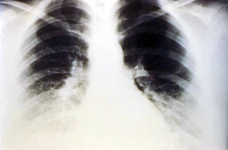 X-ray of pulmonary effusion