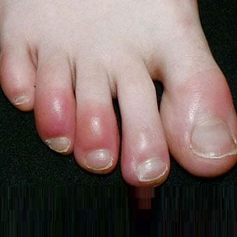 Skin rashes such as 