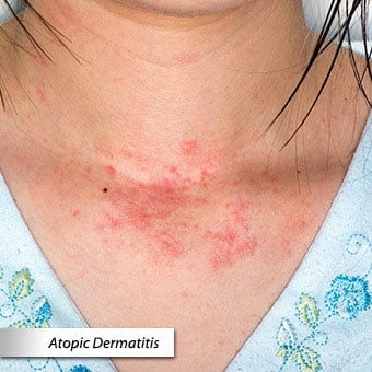 A close-up of atopic dermatitis of the neck.