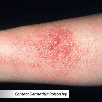 A close-up of contact dermatitis from poison ivy.