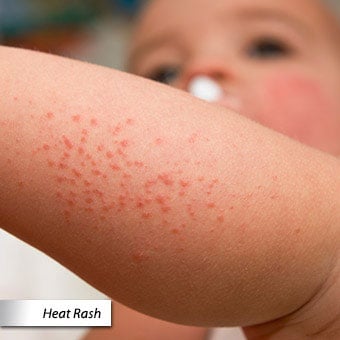 A baby's leg with heat rash.