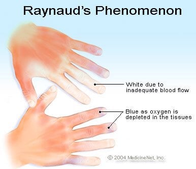 Picture of Raynaud's phenomenon