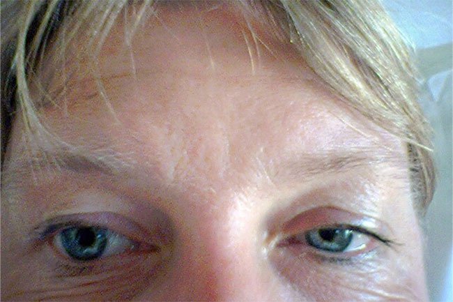 Horner syndrome can damage nerve pathways and make your eyelids sag. 