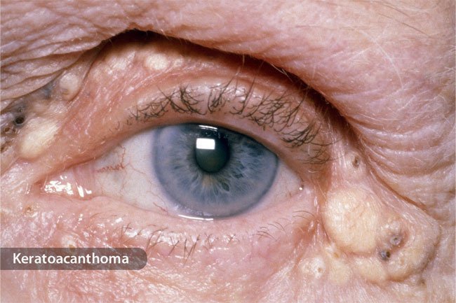 An eyelid tumor may weigh your eyelid down and cause it to droop.