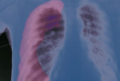 A collapsed lung creates breathing problems. 