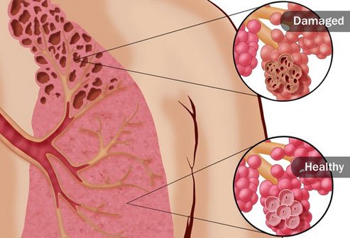 Smoking is the leading cause of COPD. 