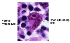 Picture of normal lymphocyte and Reed-Sternberg lymphocyte.