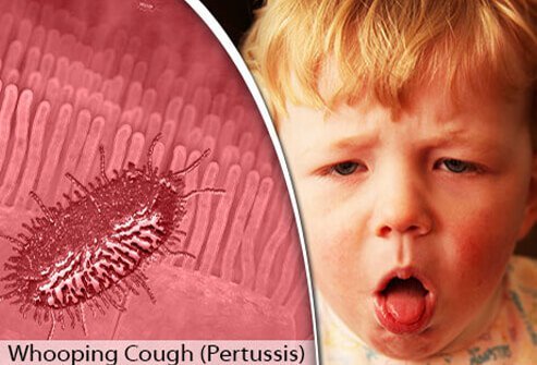 Uncontrollable, violent coughing that can make it difficult to breathe is characteristic of this lung infection.