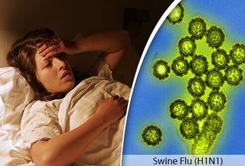 Swine flu (H1N1) is a respiratory illness caused by the Influenza-A virus.