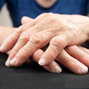 A woman's hands show swollen finger joints due to rheumatoid arthritis (RA).
