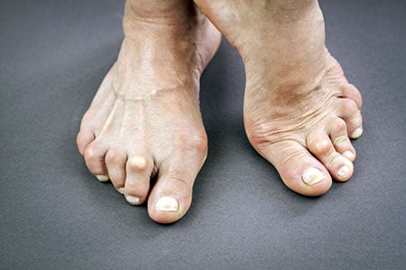 Picture of rheumatoid arthritis joint deformity in the feet