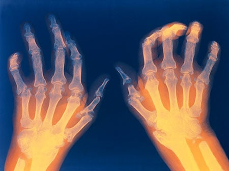 Picture of hands affected by rheumatoid arthritis. Notice the joint deformity in the fingers.