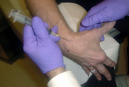 A joint aspiration procedure (arthrocentesis) may be performed to obtain joint fluid to test in the laboratory.