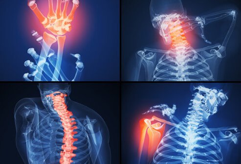 When a person with RA has symptoms including joint inflammation and pain, this is called a flare.