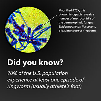 Magnified 475X, this photomicrograph reveals a number of macroconidia of the dermatophytic fungus Epidermophyton floccosum, a leading cause of ringworm.