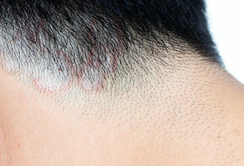 You should seek medical attention if you suspect you or your child has ringworm on the scalp. Ringworm on the scalp can only be treated with prescription medication. You should seek medical attention if you suspect you or your child has ringworm on the scalp. Ringworm on the scalp can only be treated with prescription medication.