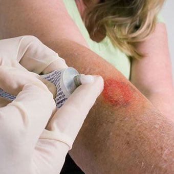 A doctor applies fungal cream to a woman with ringworm.