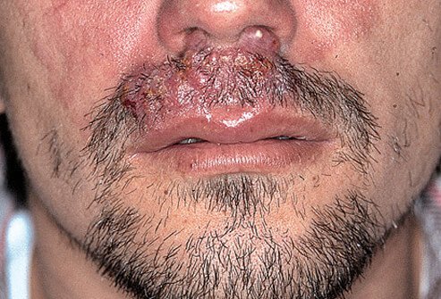 Ringworm of the beard (tinea barbae)