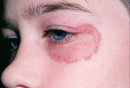 Facial ringworm is an uncommon infection, and it can arise from contact with several sources.